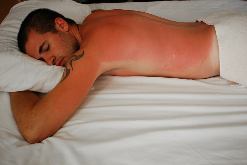 How To Sleep With Sunburn 1645 - How To Sleep With Sunburn - A Guide